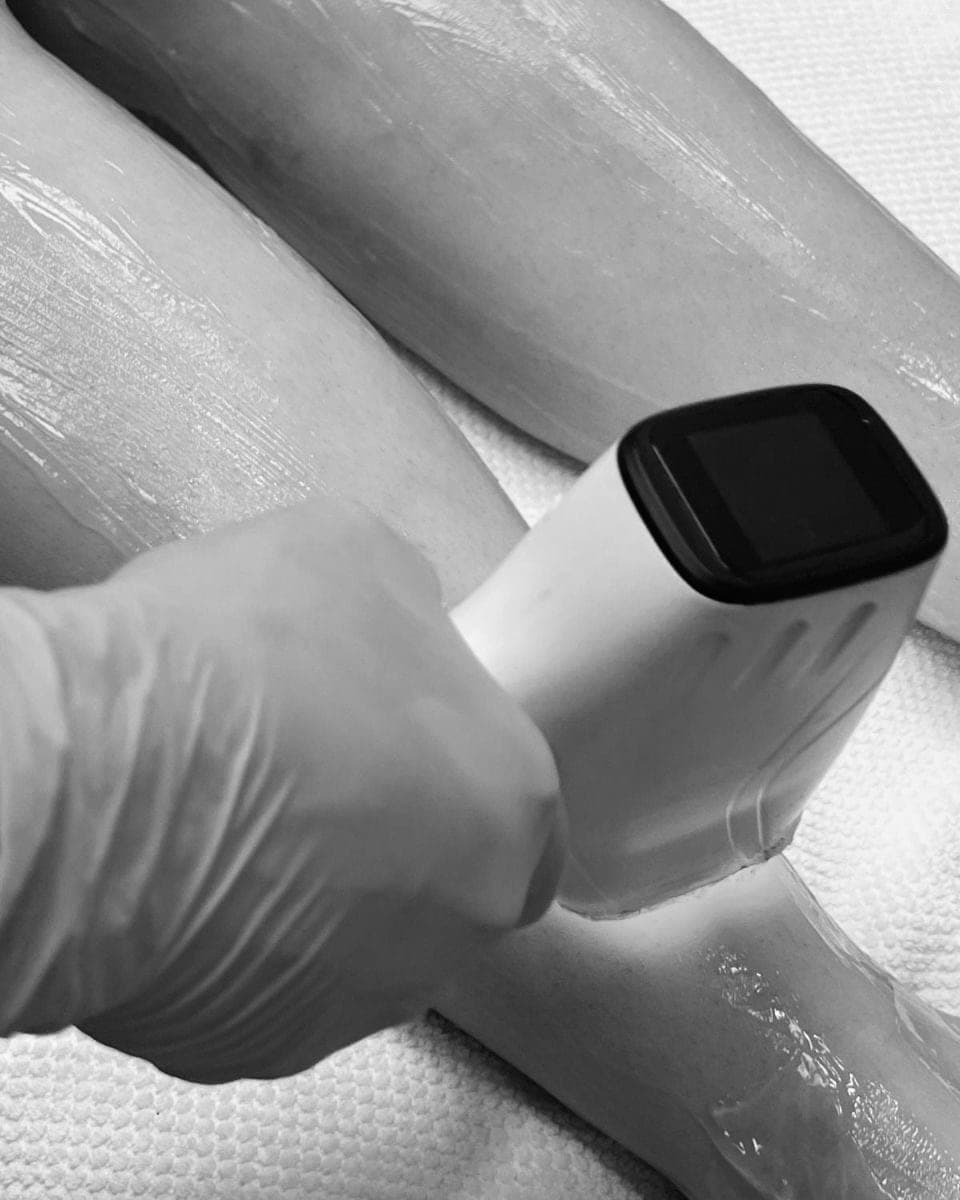 Laser hair removal